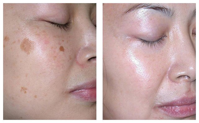 Acne & Pigmentation Care