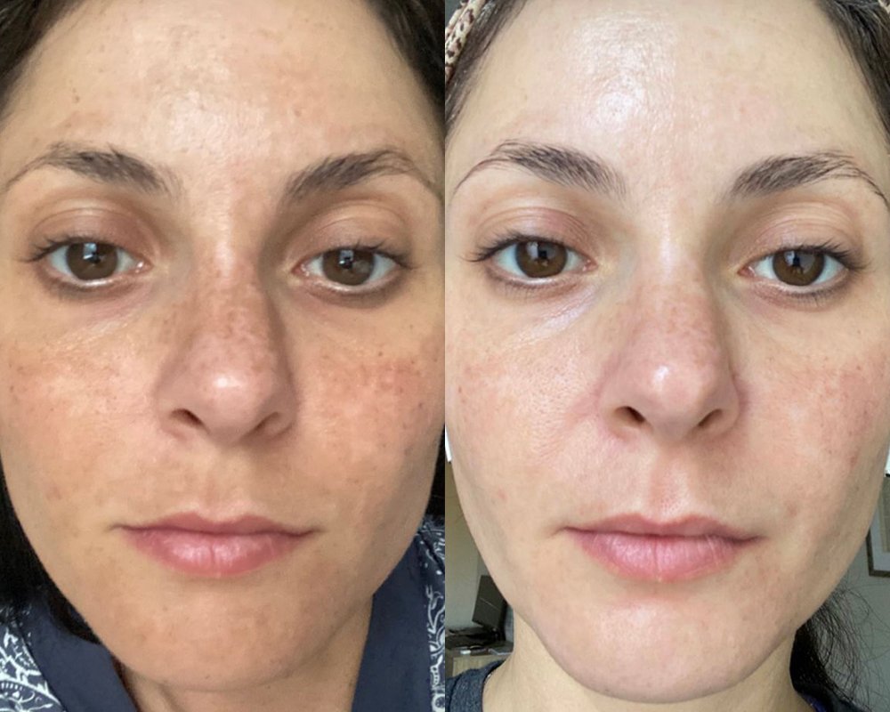 Facials & Skin Treatments